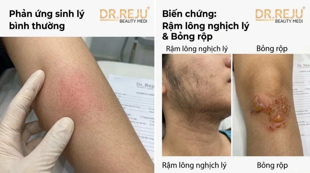 Tác hại của triệt lông vĩnh viễn: Ranh giới giữa phản ứng sinh lý và biến chứng