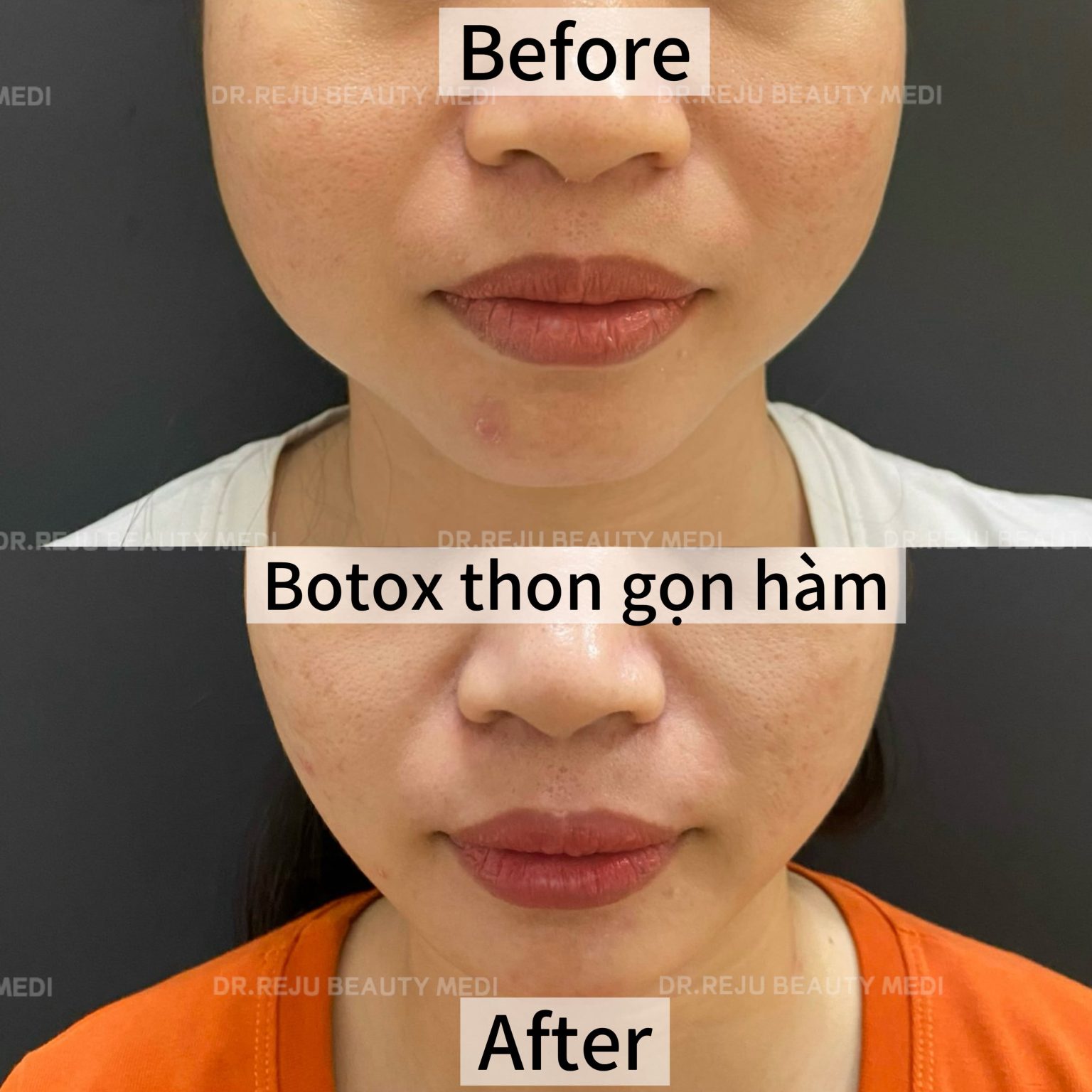 Botox Combo