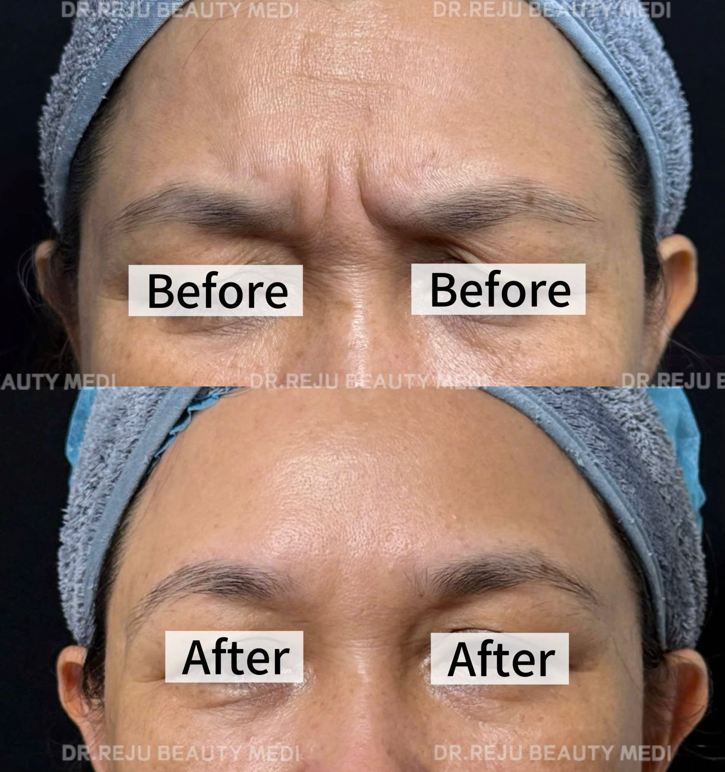 Botox Vai