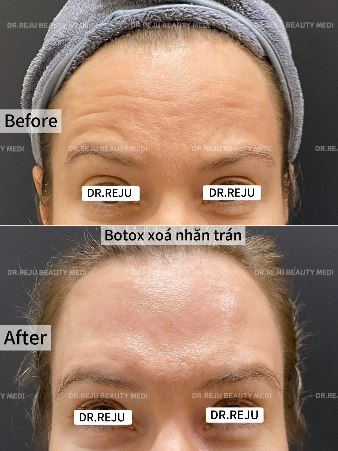 Botox Tran
