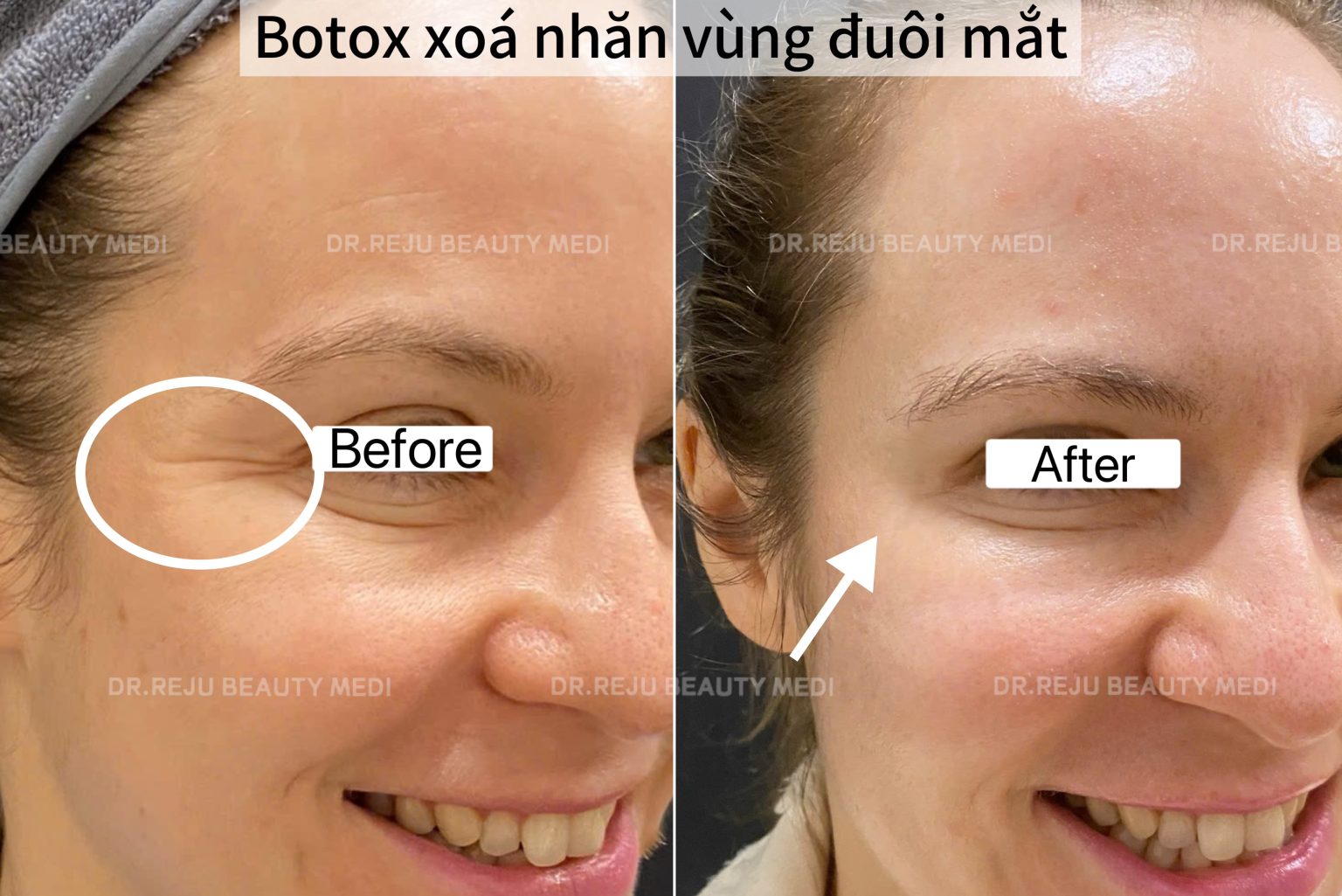 Botox Mat