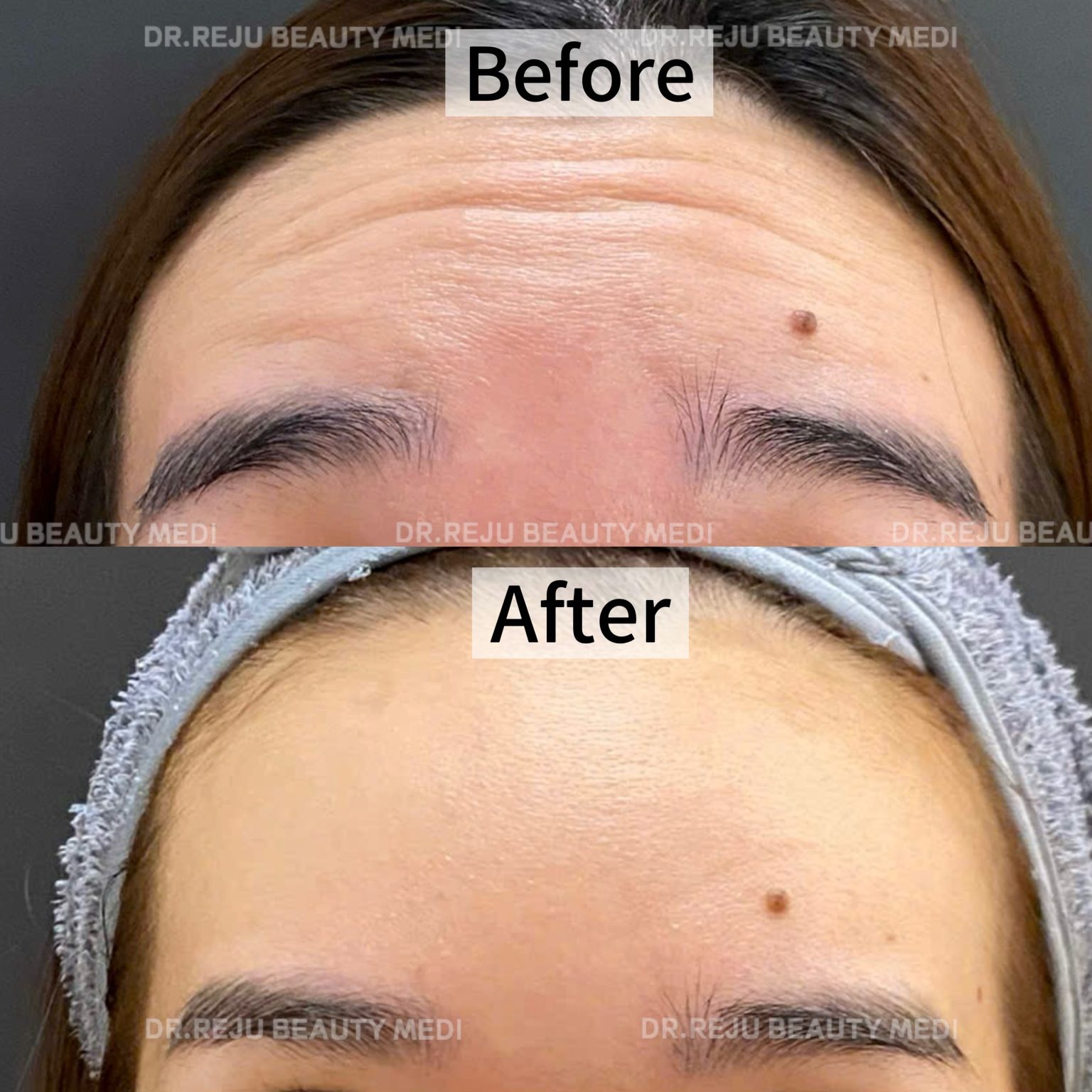 Botox Gon Ham