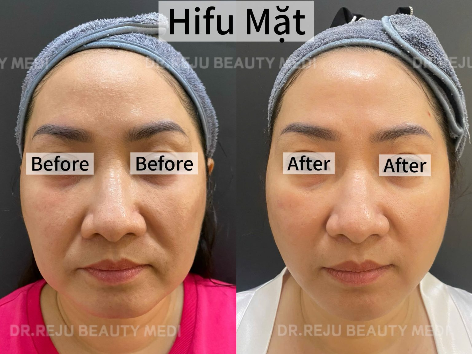 Hifu 1