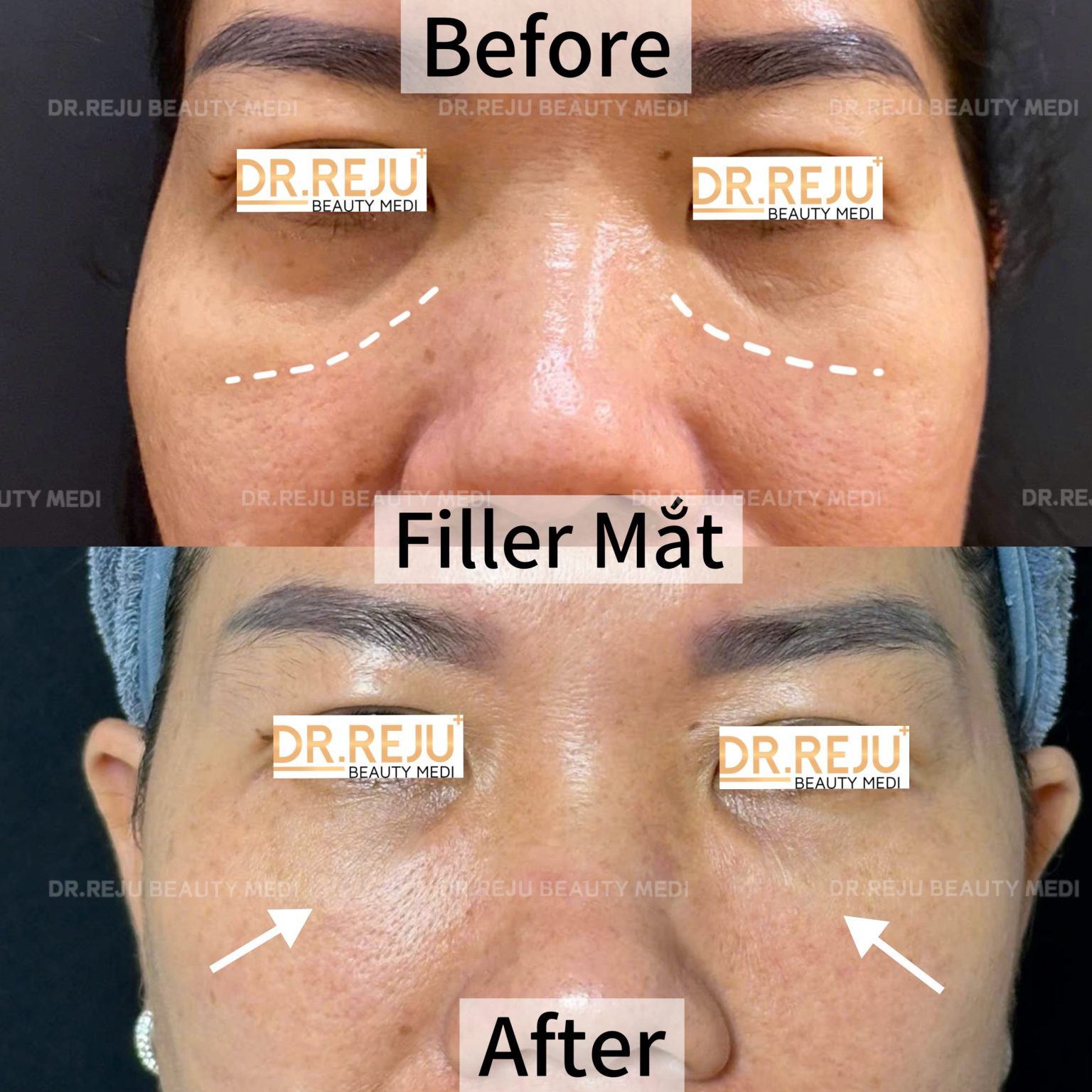Filler Moi Cam