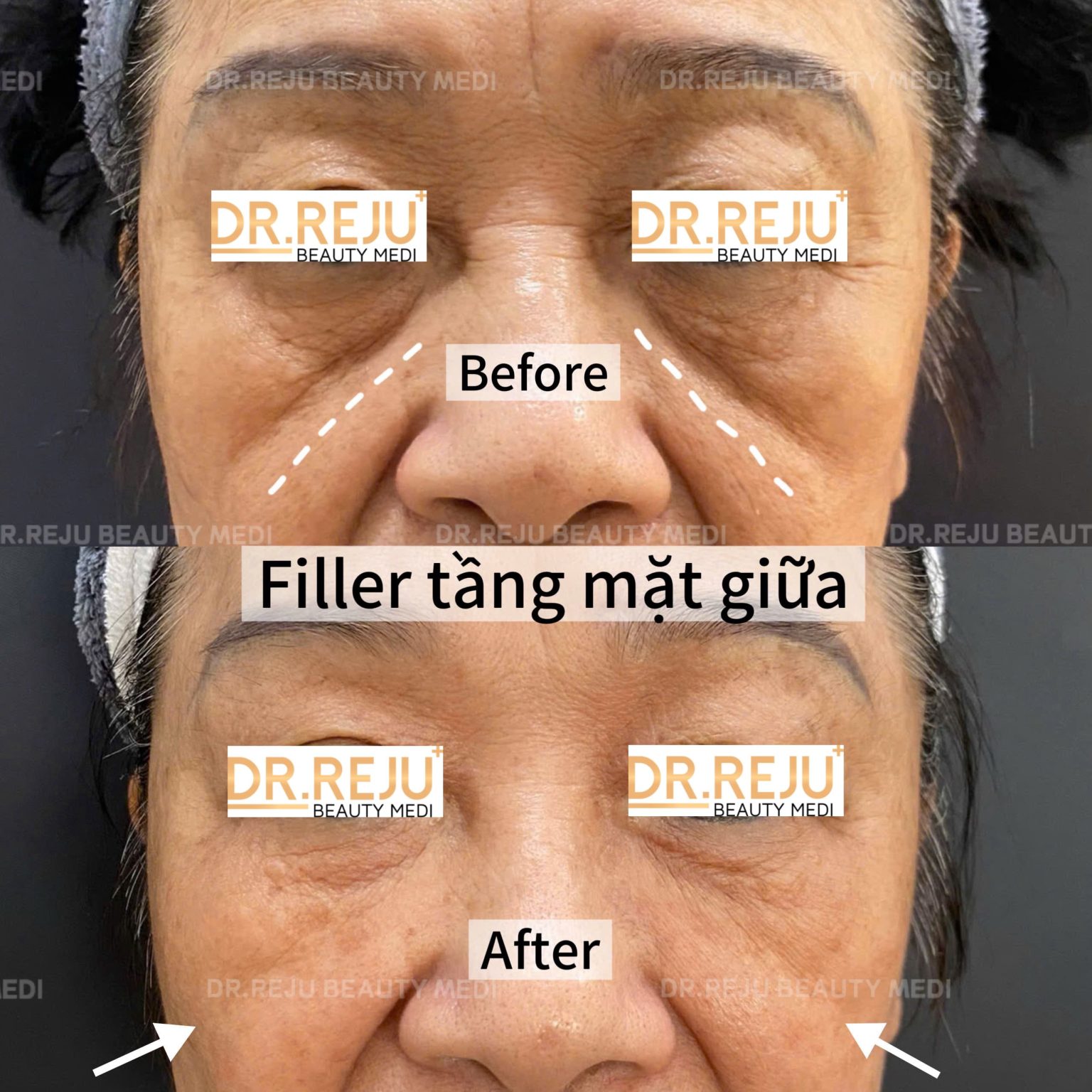 Filler Can Chinh