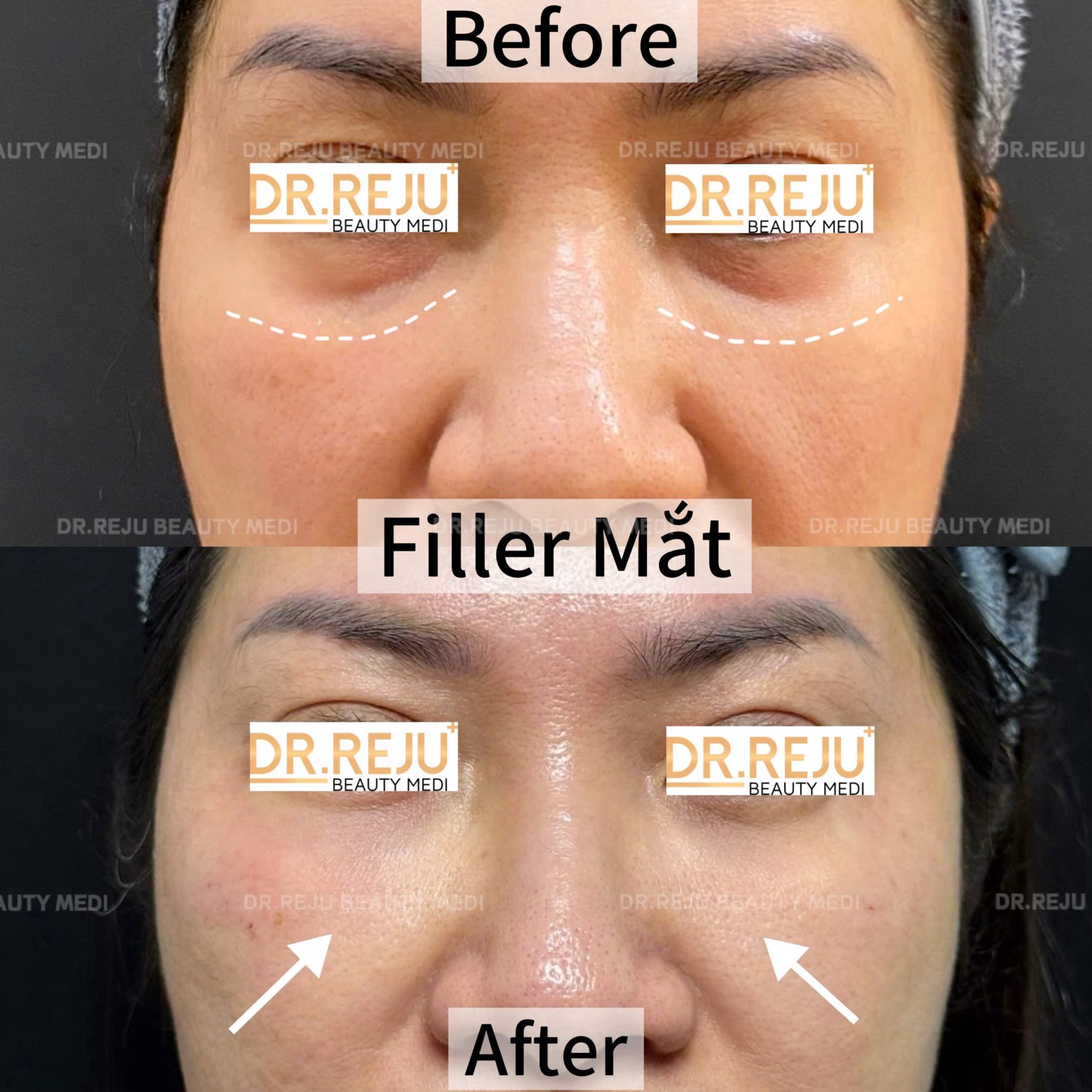 Filler Ranh Cuoi