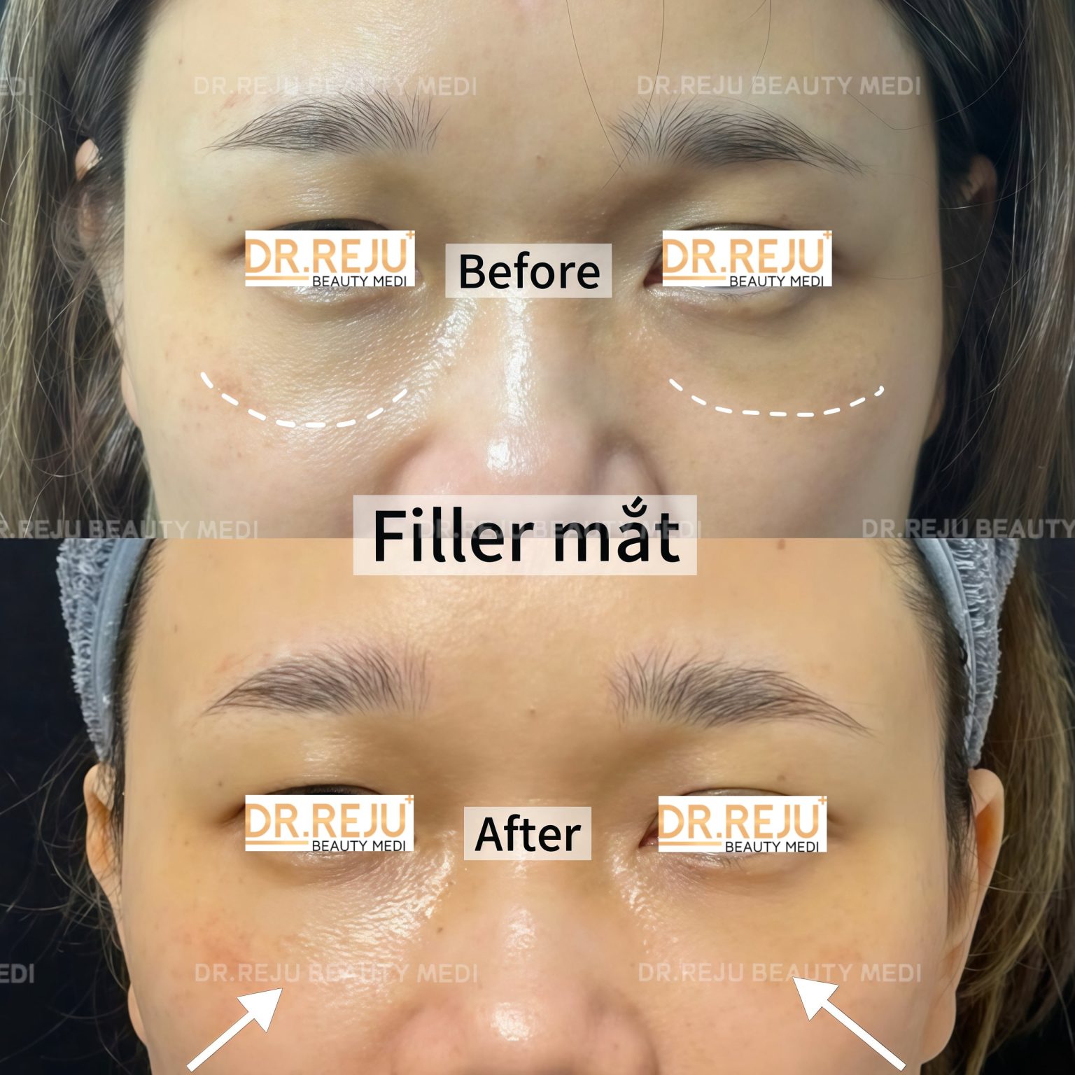 Filler Thai Duong