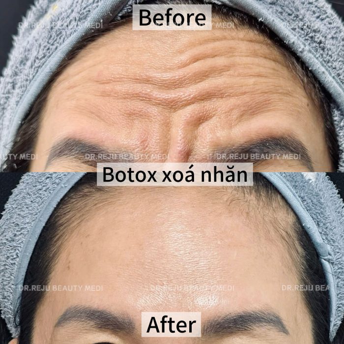Tiêm Botox - Image 7