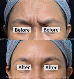 Tiêm Botox - Image 2