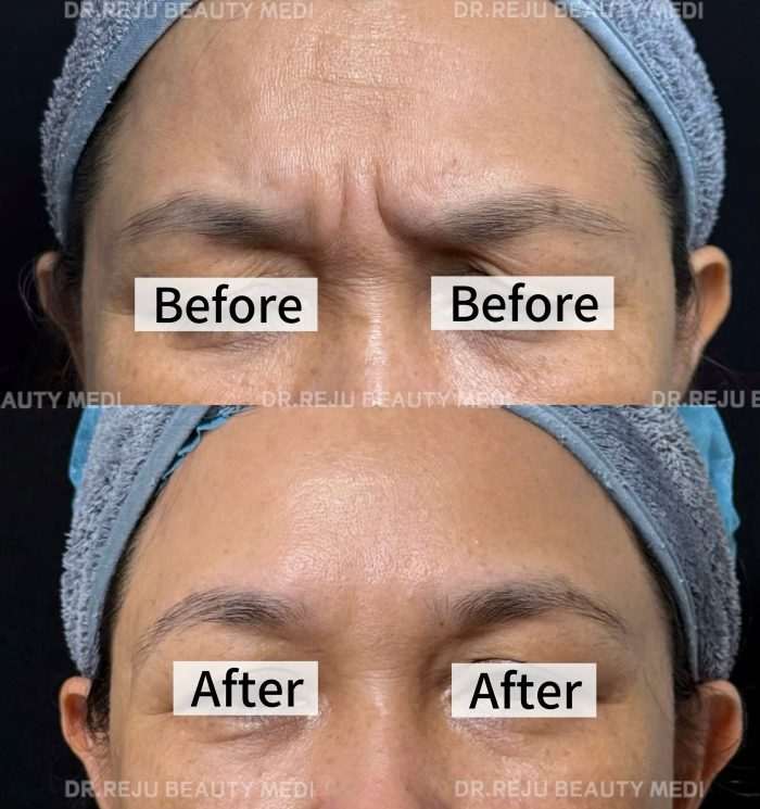 Tiêm Botox - Image 2