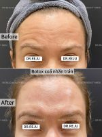 Tiêm Botox - Image 3