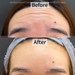 Tiêm Botox - Image 5