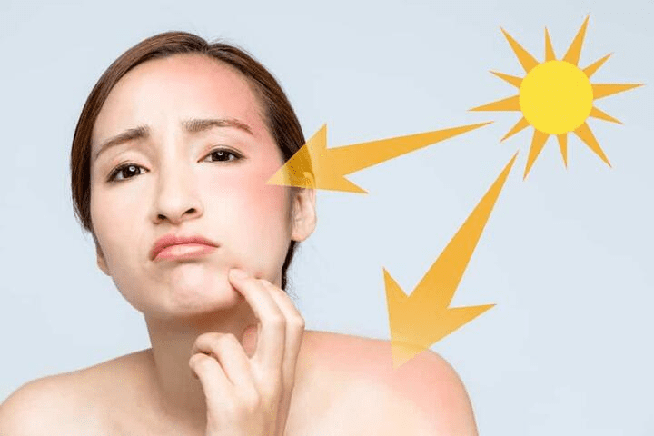 nám da do anh nắng mặt trời