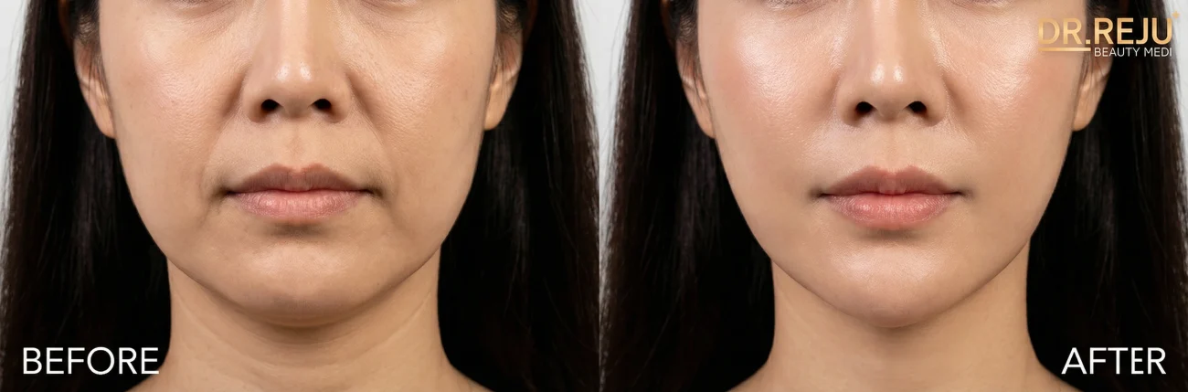 Kết quả trước và sau liệu trình nâng cơ trẻ hóa viền hàm bằng EndyMed Pro.