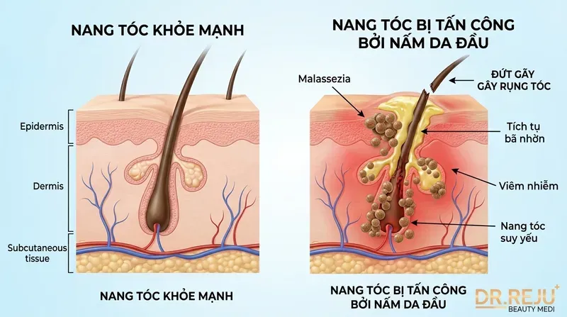 Cơ chế sinh học: Nấm da đầu tàn phá nang tóc và gây rụng tóc như thế nào?