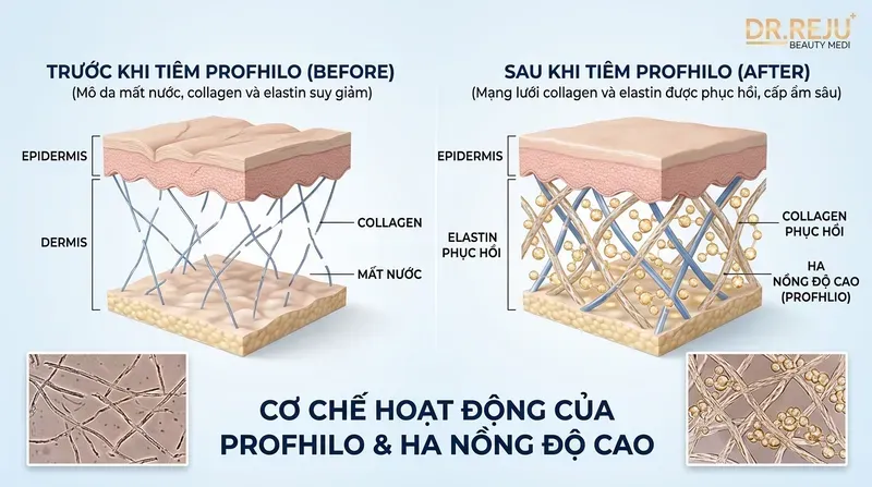 Tiêm Profhilo là gì? Cơ chế hoạt động của HA nồng độ cao