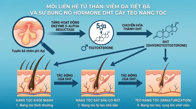 Mối liên hệ tử thần: Viêm da tiết bã và sự bùng nổ Hormone DHT gây teo nang tóc