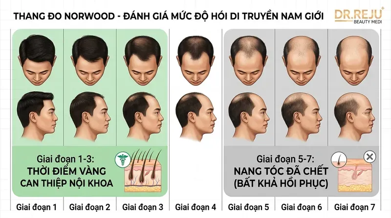 Tầm soát sớm: Cách nhận biết gen hói và ứng dụng thang đo Norwood (Dữ liệu KB)