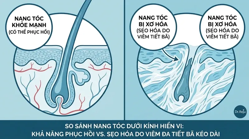 Viêm Da Tiết Bã Có Gây Rụng Tóc Vĩnh Viễn (Sẹo Hóa) Không?