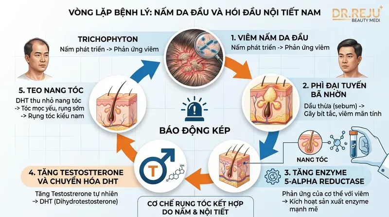 Báo động kép: Da đầu nhờn rụng tóc nam và vòng lặp hói đầu nội tiết