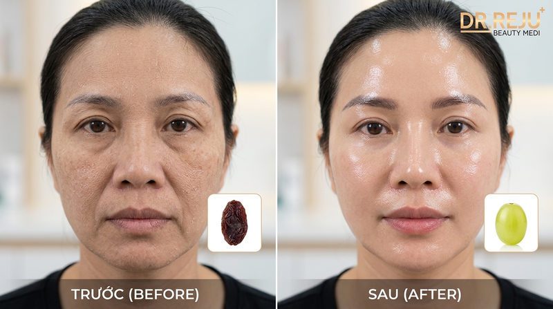 Tại sao da khô bong tróc, lão hóa sớm nên chọn tiêm BAP?