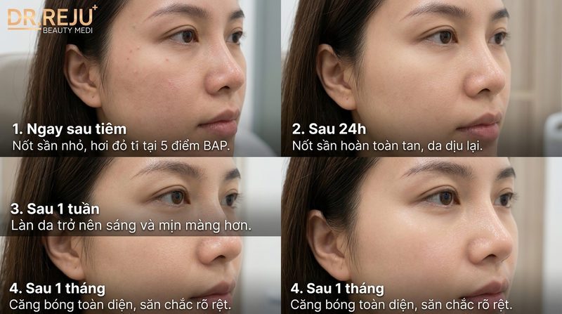 Nhật ký phục hồi & Giải mã hiện tượng nổi nốt sần sau tiêm BAP Profhilo