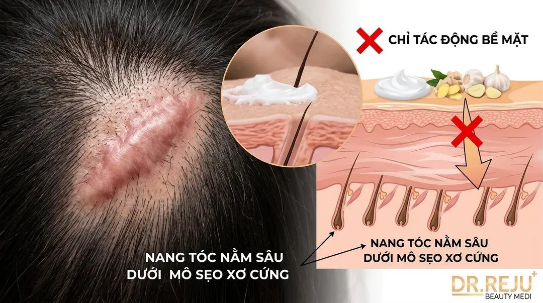 Cảnh báo: Tại sao kem bôi và mẹo dân gian vô tác dụng với sẹo nang tóc?