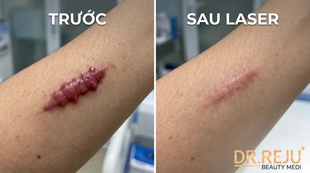 So sánh các phương pháp xóa sẹo lồi, là sẹo lồi tại Bệnh viện 108