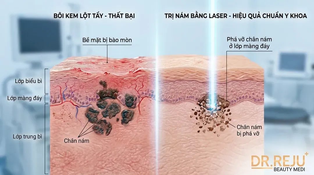 Trị nám bằng laser là gì? Tại sao bôi kem trị nám thất bại?