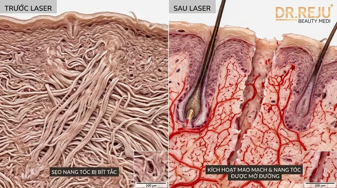 Ứng dụng chuyên sâu: Laser trị sẹo nang tóc trước khi cấy Exosome/PRP