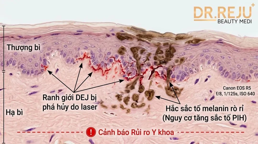 Rủi ro Y khoa: Phá hủy ranh giới DEJ và nguy cơ tăng sắc tố PIH