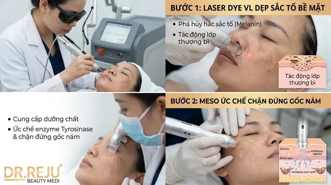 Phác đồ trị nám chuẩn y khoa: Kết hợp Laser và Meso ức chế